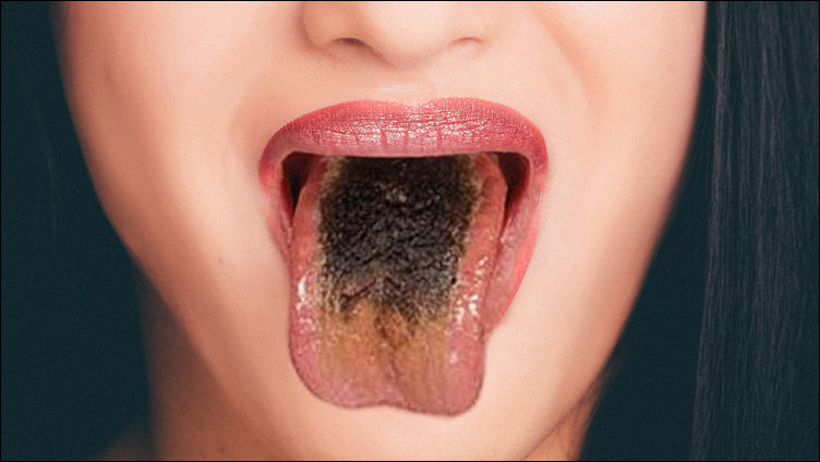 Black Hairy Tongue