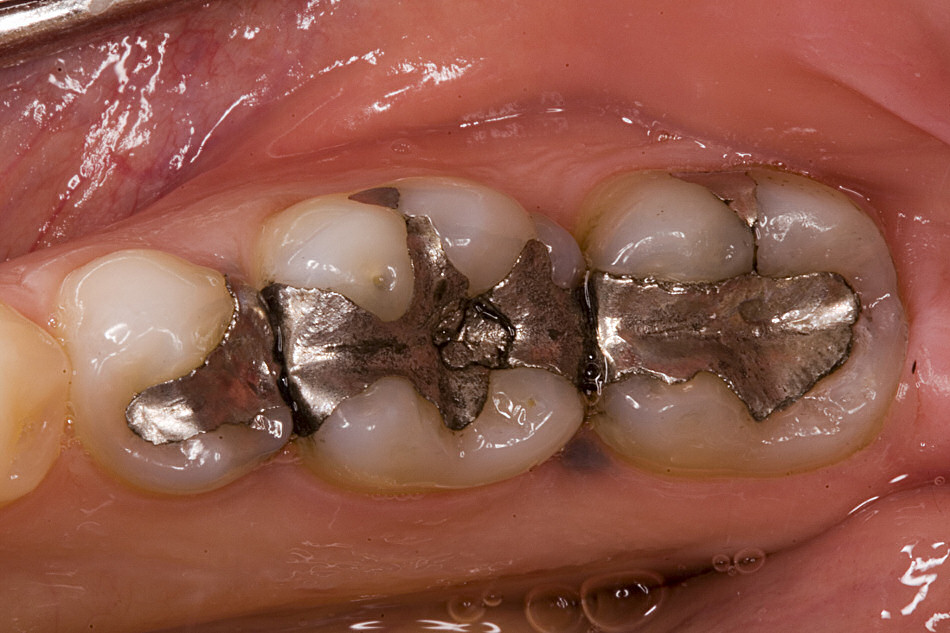 Dentists add mercury to your teeth so that you can breathe the poisonous vapour for the remainder of your life...