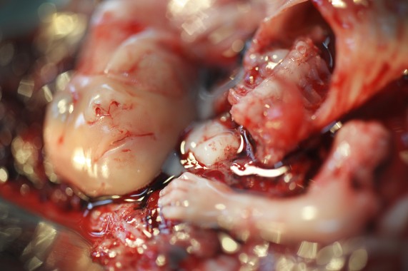 Aborted fetal parts